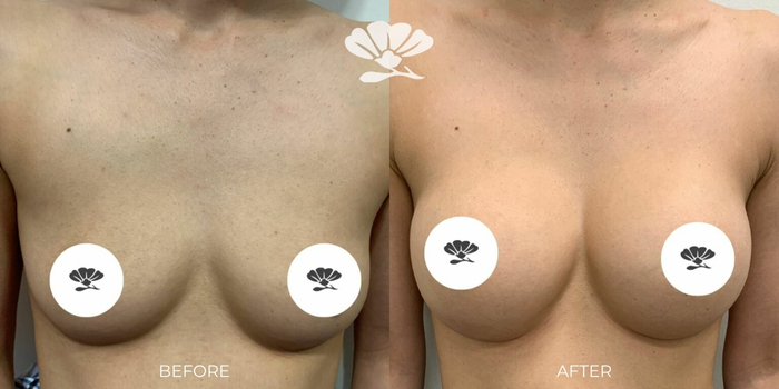 Breast augmentation surgery Perth
