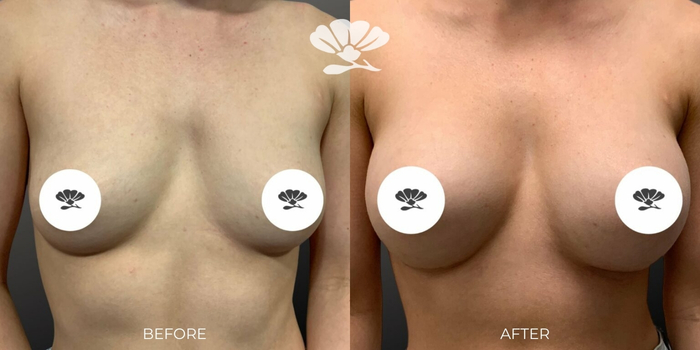 Breast Implant Surgery Perth