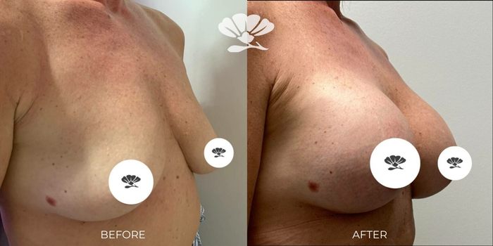 https://www.absolutemakeover.com.au/wp-content/uploads/2023/08/Breast-Augmentation-Boob-Job-Before-After-Perth-4.jpg