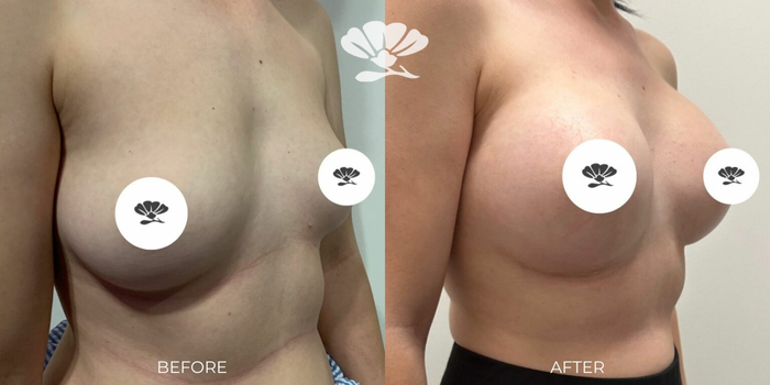 Breast implant surgery before and after