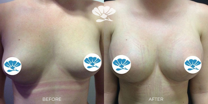 Breast Augmentation Perth by Dr Glenn Murray