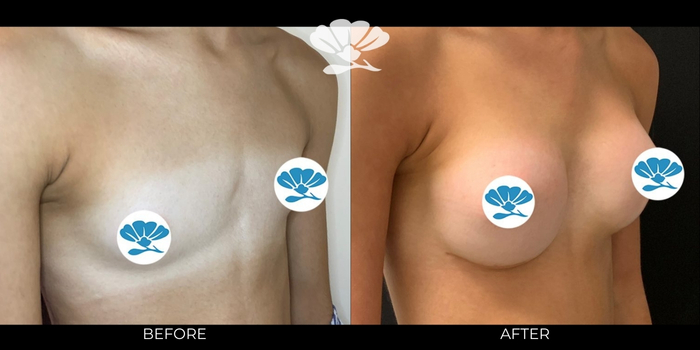 Breast Augmentation Perth by Dr Glenn Murray