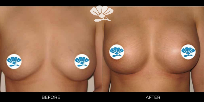 Breast Implants Perth by Dr Glenn Murray