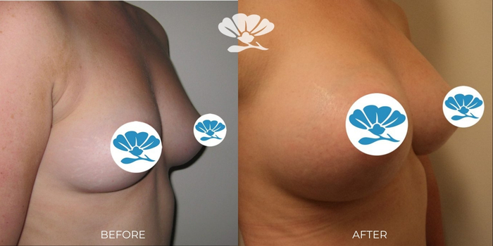 Breast Augmentation performed by Dr Glenn Murray Perth