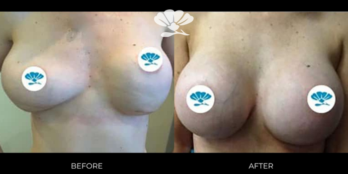 Breast Implant Repair Perth by Dr Glenn Murray