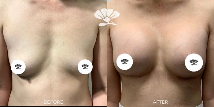 300 CC breast implants perth