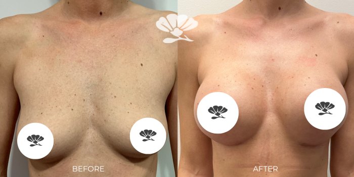 Breast Augmentation - Perth Before and After by Dr Glenn Murray