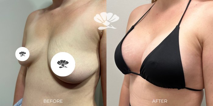 Breast Implant Surgery Perth Before and After by Dr Glenn Murray