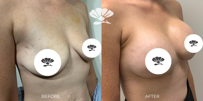 Perth breast enlargement surgery before after