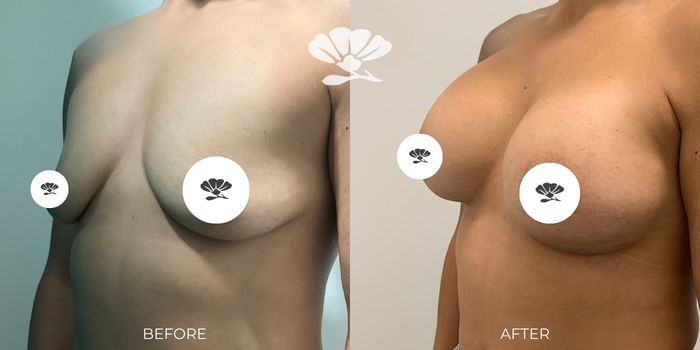 breast augmentation results Perth