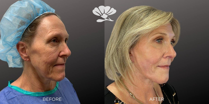 Erbium Laser skin resurfacing for the face Perth - before and after