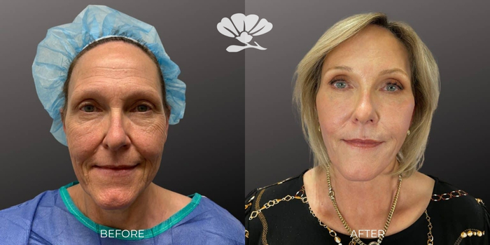 Erbium Laser skin resurfacing for the face by Doctor Glenn Murray Perth