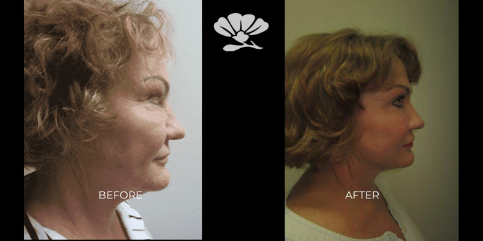 Erbium Laser facial skin resurfacing Perth - before and after