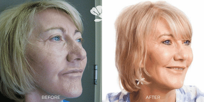 Erbium Laser facial skin resurfacing - before and after