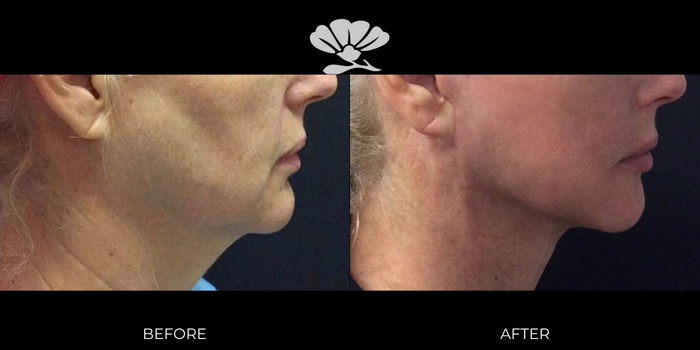 Before and After Erbium Laser facial skin resurfacing Perth