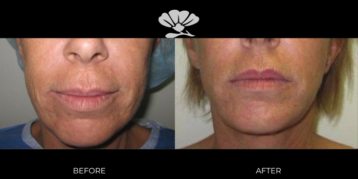 Before and After Erbium Laser facial skin resurfacing Perth