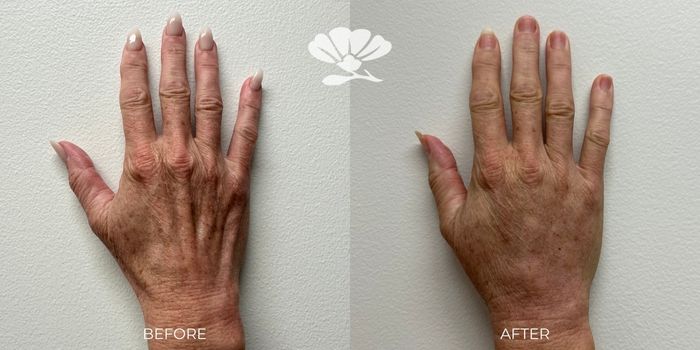 Erbium Laser Skin Resurfacing and Fat Transfer to the Hands by Doctor Glenn Murray Perth