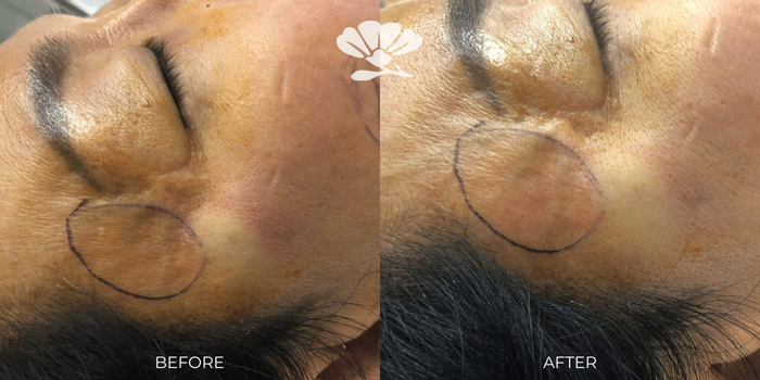 Fat transfer surgery to the face and temples - before and after