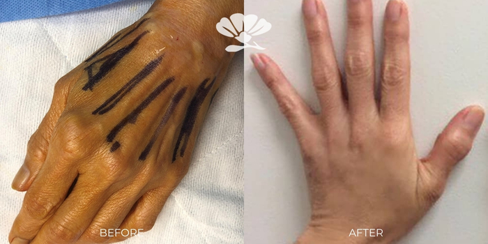 Fat transfer to hands Perth before and after