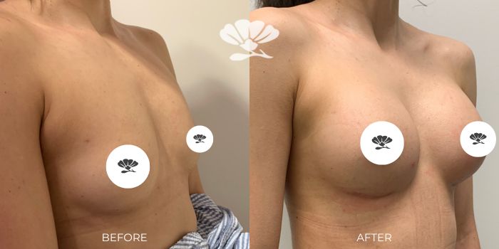 Before and After Breast Augmentation Perth by Dr Glenn Murray