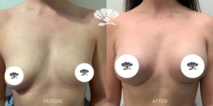 Breast Implant Surgery Perth Before and After by Doctor Glenn Murray