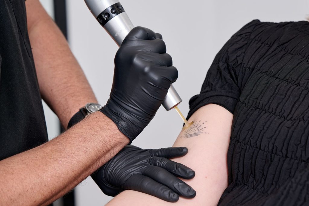 Perth Best Laser Tattoo Removal and Pricing