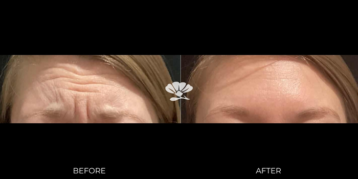 Perth botox injections to forehead wrinkles