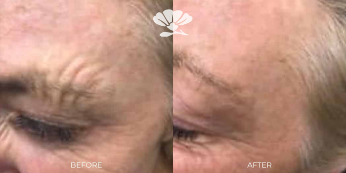 Wrinkle relaxers Perth forehead and eyebrows