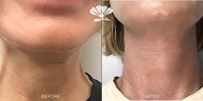 Platysma injections anti-wrinkle Perth before and after