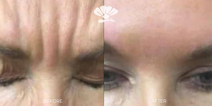 anti-wrinkle injections to the frown and forehead lines Perth Northern Suburbs