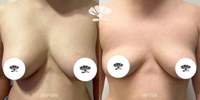 Breast explant removal Perth surgery