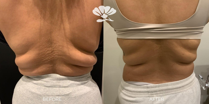 Coolsculpting Fat Freezing Perth Before and After Results