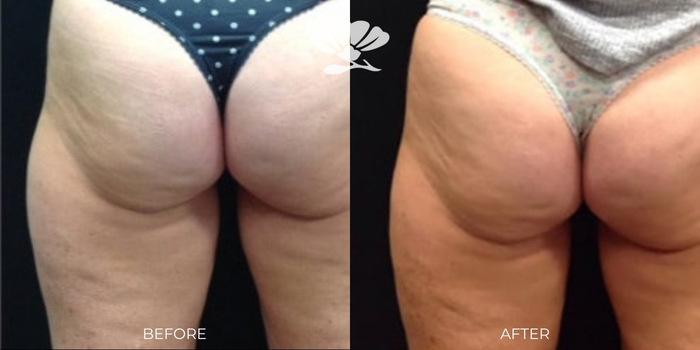 Coolsculpting Fat Freezing Thighs and Buttocks Perth Before and After Results