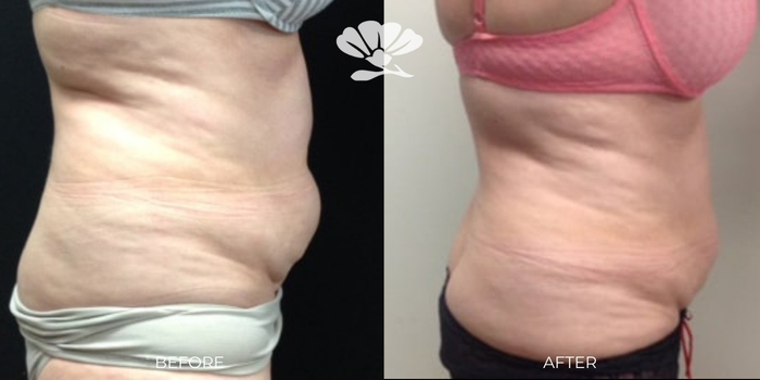 Coolsculpting Fat Freezing Tummy Perth Before and After Results