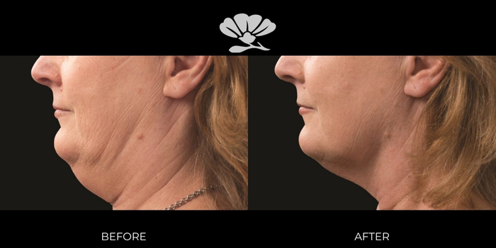 Coolsculpting Fat Freezing Perth Chin Before and After Results