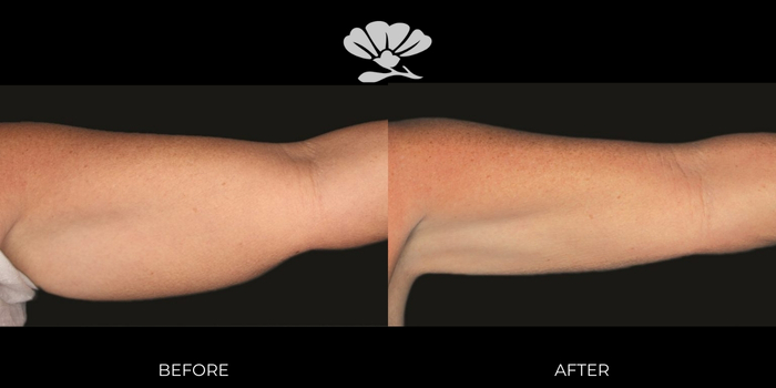 Coolsculpting Fat Freezing Arms Perth Before and After Results