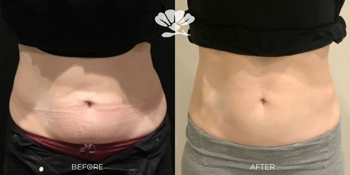 Coolsculpting Fat Freezing Abdomen Perth Before and After Results