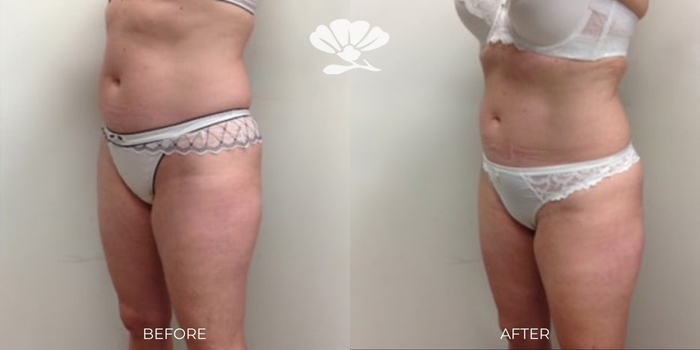 Coolsculpting Fat Freezing Stomach Perth Before and After Results