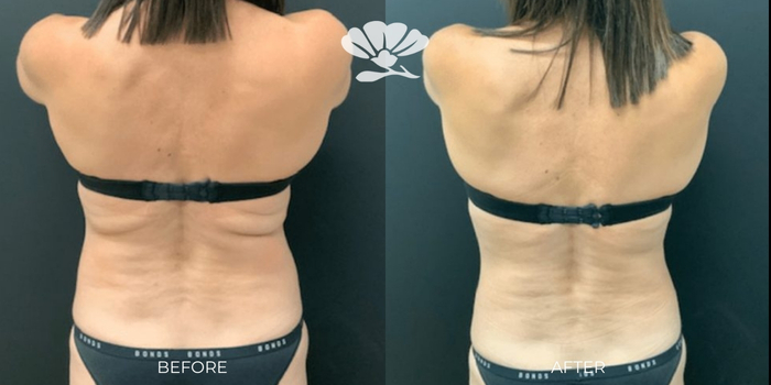 Coolsculpting Fat Freezing Bra Fat Back Perth Before and After Results