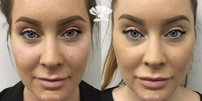 Cheek filler before and after