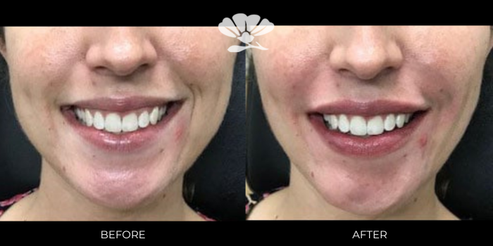 Dermal filler to smile lines and lips Perth