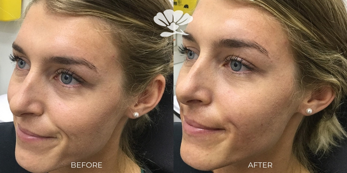 Smile line filler Perth before and after