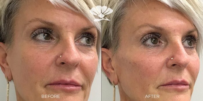 Cheek filler Perth before and after
