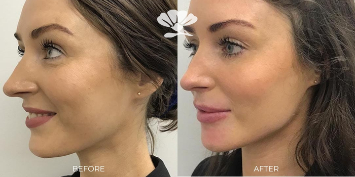 Chin and jawline filler Perth - before and after photo