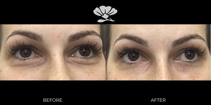 Under eye filler injections Perth before and after