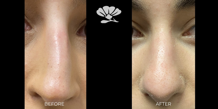 Non Surgical Injectable Rhinoplasty Dermal Filler Perth Before and After