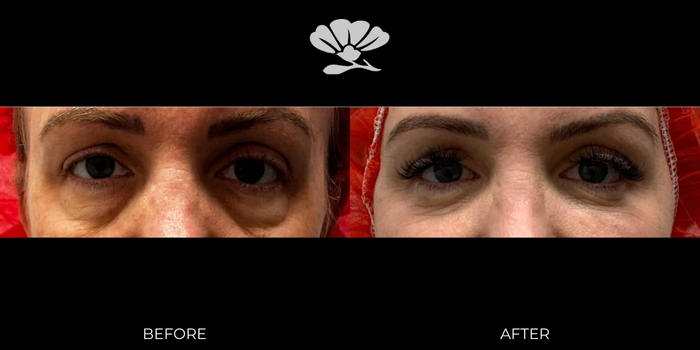 Blepharoplasty before and after Perth eyelid surgery