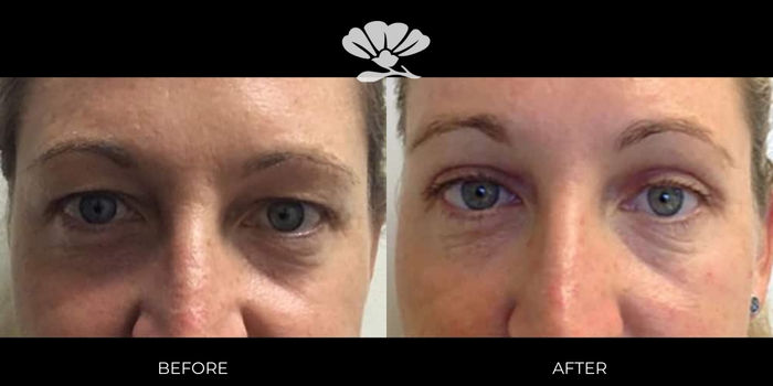 Before and After Upper Eyelid Reduction Surgery (Upper Blepharoplasty) Perth