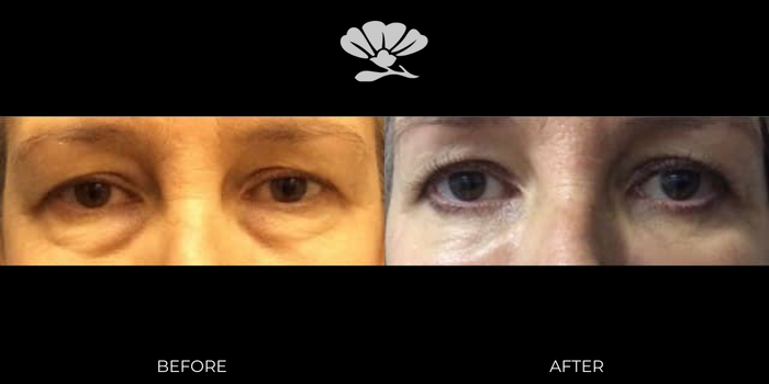 Lower Blepharoplasty Perth. Before and after surgery.