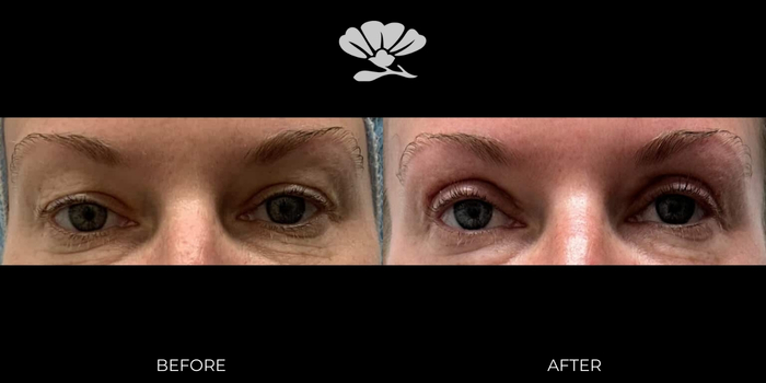 Perth Blepharoplasty before and after eyelid surgery